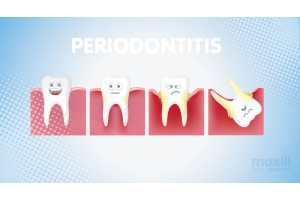 stages of periodontitis 