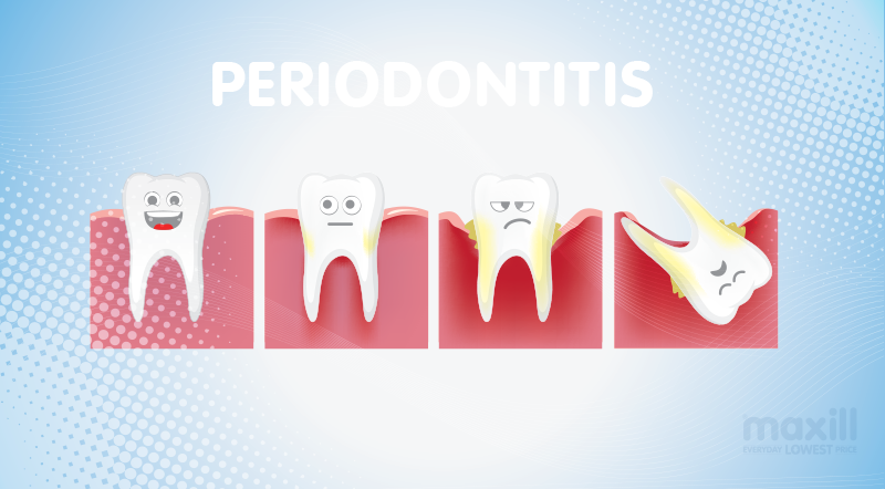 stages of periodontitis 